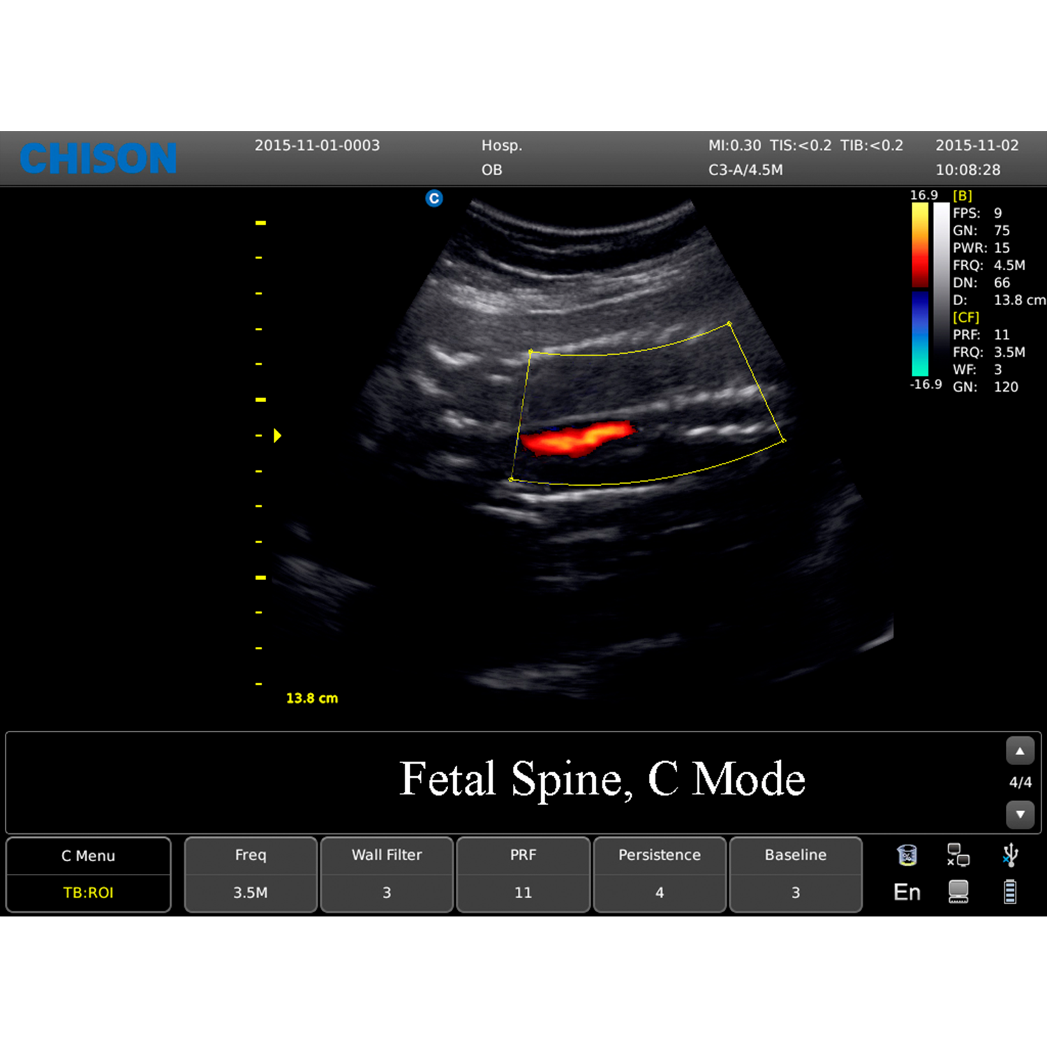 ECO 6 espina fetal CMode